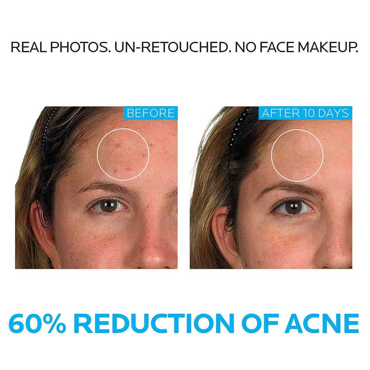 La Roche-Posay Effaclar Dermatological 3-Step Acne Treatment System