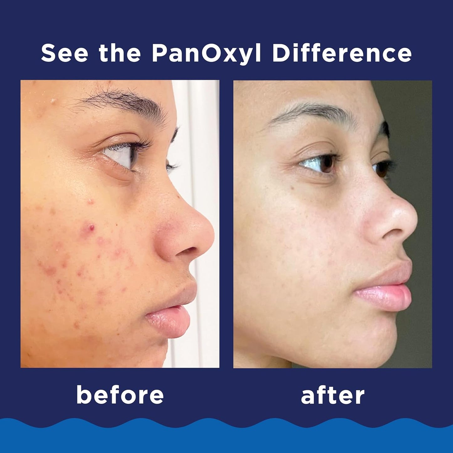 PanOxyl Acne Foaming Wash 10% Benzoyl Peroxide